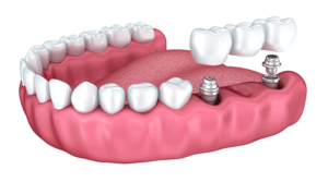 implante dental en alicante