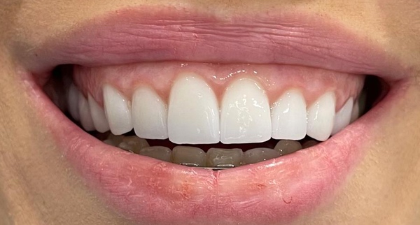 colocación de las carillas dentales